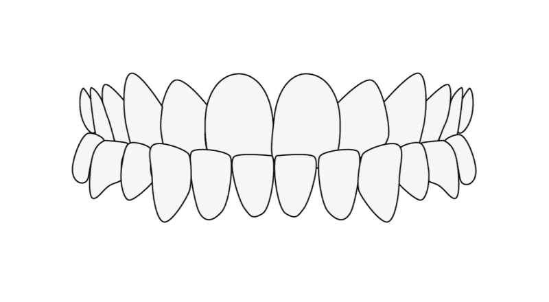 Zahnfehlstellung Unterbiss new
