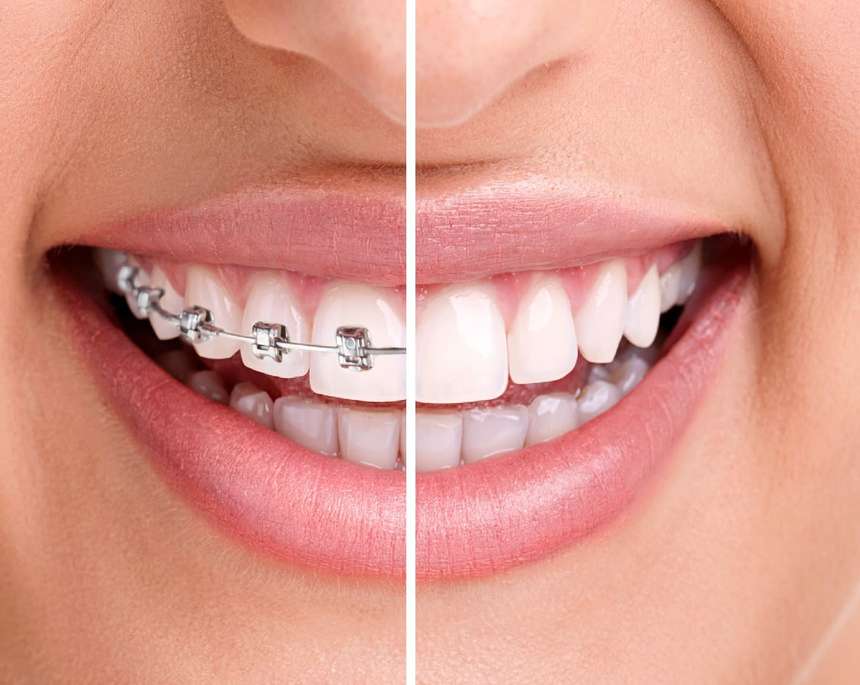geteiltes Vergleichsbild Zahnspange links im Mund, Zahnschiene rechts im Mund