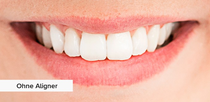 without-aligners UK